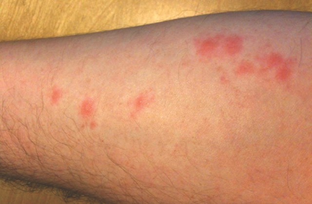 Man's leg with red blotches from bed bug bites